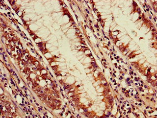 Immunohistochemistry of paraffin-embedded human colon cancer using the antibody at dilution of 1:100Rabbit anti-Human PDS5A Polyclonal Antibody