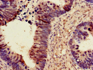 Immunohistochemistry of paraffin-embedded human ovarian cancer using PDS5A Antibody at dilution of 1:100Rabbit anti-Human PDS5A Polyclonal Antibody