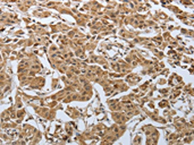 The image on the left is immunohistochemistry of paraffin-embedded Human lung cancer tissue using PSMD6 Antibody(PSMD6 Antibody) at dilution 1/50, on the right is treated with synthetic peptide. (Original magnification: ×200)Rabbit anti-Human PSMD6 Polyclonal Antibody