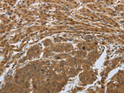 The image on the left is immunohistochemistry of paraffin-embedded Human liver cancer tissue using the antibody Antibody) at dilution 1/50, on the right is treated with synthetic peptide. (Original magnification: ×200)Rabbit anti-Human PSMD6 Polyclonal Antibody
