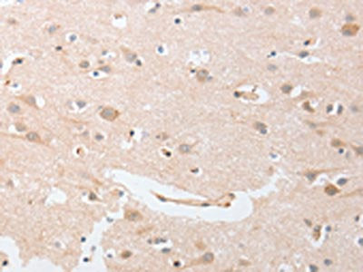 The image on the left is immunohistochemistry of paraffin-embedded Human brain  tissue using CDKN2C Antibody(CDKN2C Antibody) at dilution 1/25, on the right is treated with fusion protein. (Original magnification: ×200)Rabbit anti-Human CDKN2C Polyclonal Antibody