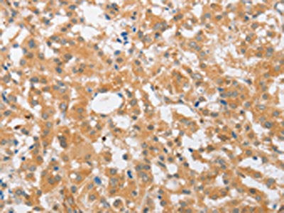 The image on the left is immunohistochemistry of paraffin-embedded Human thyroid cancer tissue using the antibody Antibody) at dilution 1/25, on the right is treated with fusion protein. (Original magnification: ×200)Rabbit anti-Human CDKN2C Polyclonal Antibody