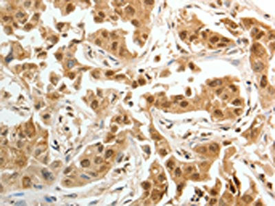 The image on the left is immunohistochemistry of paraffin-embedded Human lung cancer tissue using PSMD14 Antibody(PSMD14 Antibody) at dilution 1/20, on the right is treated with fusion protein. (Original magnification: ×200)Rabbit anti-Human PSMD14 Polyclonal Antibody