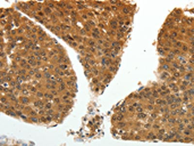 The image on the left is immunohistochemistry of paraffin-embedded Human liver cancer tissue using the antibody Antibody) at dilution 1/20, on the right is treated with fusion protein. (Original magnification: ×200)Rabbit anti-Human PSMD14 Polyclonal Antibody