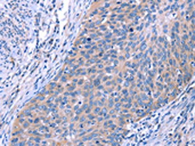 The image on the left is immunohistochemistry of paraffin-embedded Human cervical cancer tissue using ESPL1 Antibody(ESPL1 Antibody) at dilution 1/40, on the right is treated with synthetic peptide. (Original magnification: ×200)Rabbit anti-Human ESPL1 Polyclonal Antibody