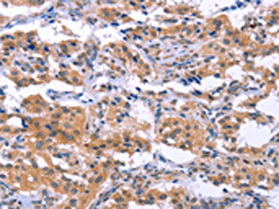 The image on the left is immunohistochemistry of paraffin-embedded Human thyroid cancer tissue using the antibody Antibody) at dilution 1/40, on the right is treated with synthetic peptide. (Original magnification: ×200)Rabbit anti-Human ESPL1 Polyclonal Antibody