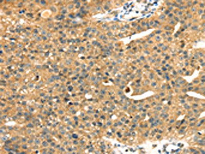 The image on the left is immunohistochemistry of paraffin-embedded Human breast cancer tissue using MAPK12 Antibody(MAPK12 Antibody) at dilution 1/25, on the right is treated with fusion protein. (Original magnification: ×200)