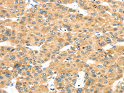 The image on the left is immunohistochemistry of paraffin-embedded Human liver cancer tissue using the antibody Antibody) at dilution 1/25, on the right is treated with fusion protein. (Original magnification: ×200)