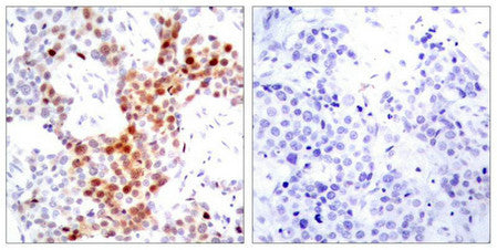 Immunohistochemical analysis of paraffin-embedded human breast carcinoma tissue using ATF2(Phospho-Thr69 or 51) Antibody(left) or the same antibody preincubated with blocking peptide(right).Rabbit anti-Human ATF2 Polyclonal Antibody