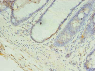Immunohistochemistry of paraffin-embedded human colon cancer using CCDC57 Antibody at dilution of 1:100