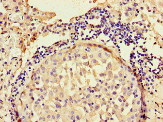 Immunohistochemistry of paraffin-embedded human lung cancer using the antibody at dilution of 1:100Rabbit anti-Human ANO4 Polyclonal Antibody