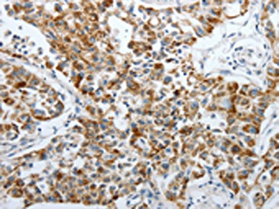 The image on the left is immunohistochemistry of paraffin-embedded Human lung cancer tissue using PDK2 Antibody(PDK2 Antibody) at dilution 1/40, on the right is treated with synthetic peptide. (Original magnification: ×200)Rabbit anti-Human PDK2 Polyclonal Antibody