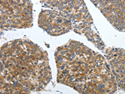 The image on the left is immunohistochemistry of paraffin-embedded Human liver cancer tissue using the antibody Antibody) at dilution 1/40, on the right is treated with synthetic peptide. (Original magnification: ×200)Rabbit anti-Human PDK2 Polyclonal Antibody