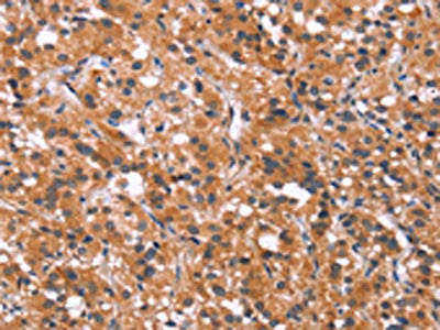The image on the left is immunohistochemistry of paraffin-embedded Human thyroid cancer tissue using the antibody  Antibody) at dilution 1/30, on the right is treated with synthetic peptide. (Original magnification: ×200)