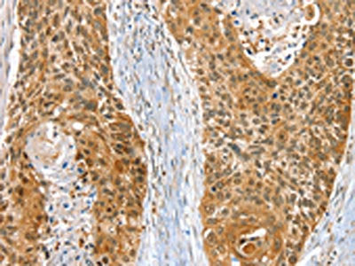 The image on the left is immunohistochemistry of paraffin-embedded Human esophagus cancer tissue using RAB27A Antibody(RAB27A Antibody) at dilution 1/30, on the right is treated with fusion protein. (Original magnification: ×200)Rabbit anti-Human RAB27A Polyclonal Antibody
