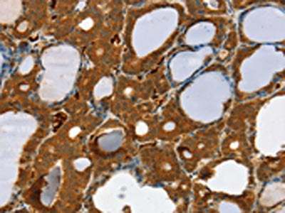 The image on the left is immunohistochemistry of paraffin-embedded Human thyroid cancer tissue using the antibody Antibody) at dilution 1/30, on the right is treated with fusion protein. (Original magnification: ×200)Rabbit anti-Human RAB27A Polyclonal Antibody