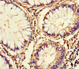 Immunohistochemistry of paraffin-embedded human colon cancer using FAM161A Antibody at dilution of 1:100Rabbit anti-Human FAM161A Polyclonal Antibody