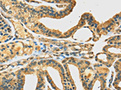 The image on the left is immunohistochemistry of paraffin-embedded Human thyroid cancer tissue using DHCR24 Antibody(DHCR24 Antibody) at dilution 1/35, on the right is treated with fusion protein. (Original magnification: ×200)Rabbit anti-Human DHCR24 Polyclonal Antibody