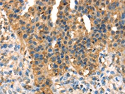 The image on the left is immunohistochemistry of paraffin-embedded Human breast cancer tissue using the antibody Antibody) at dilution 1/35, on the right is treated with fusion protein. (Original magnification: ×200)Rabbit anti-Human DHCR24 Polyclonal Antibody