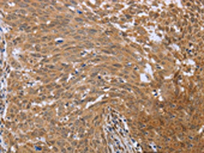 The image on the left is immunohistochemistry of paraffin-embedded Human cervical cancer tissue using the antibody Antibody) at dilution 1/40, on the right is treated with fusion protein. (Original magnification: ×200)Rabbit anti-Human FHL2 Polyclonal Antibody