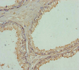 Immunohistochemistry of paraffin-embedded human prostate cancer using FBXO7 Antibody at dilution of 1:100
