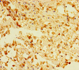 Immunohistochemistry of paraffin-embedded human melanoma using ACOT6 Antibody at dilution of 1:100