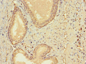 Immunohistochemistry of paraffin-embedded human prostate cancer using CERKL Antibody at dilution of 1:100Rabbit anti-Human CERKL Polyclonal Antibody