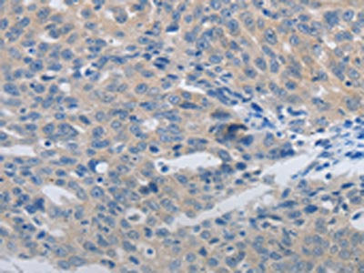 The image is immunohistochemistry of paraffin-embedded Human ovarian cancer tissue using MMP8 Antibody(MMP8 Antibody) at dilution 1/45. (Original magnification: ×200)Rabbit anti-Human MMP8 Polyclonal Antibody