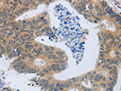 The image is immunohistochemistry of paraffin-embedded Human colon cancer tissue using the antibody Antibody) at dilution 1/45. (Original magnification: ×200)