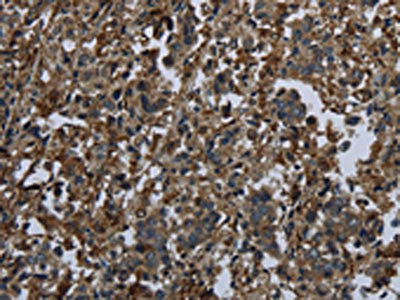 The image on the left is immunohistochemistry of paraffin-embedded Human liver cancer tissue using GLUL Antibody(GLUL Antibody) at dilution 1/60, on the right is treated with fusion protein. (Original magnification: ×200)Rabbit anti-Human GLUL Polyclonal Antibody