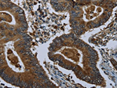The image on the left is immunohistochemistry of paraffin-embedded Human colon cancer tissue using the antibody Antibody) at dilution 1/60, on the right is treated with fusion protein. (Original magnification: ×200)Rabbit anti-Human GLUL Polyclonal Antibody