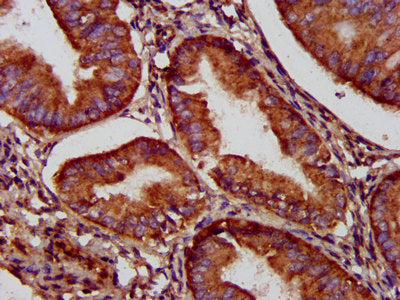 IHC image of NADK2 Antibody diluted at 1:500 and staining in paraffin-embedded human endometrial cancer performed on a Leica BondTM system. After dewaxing and hydration, antigen retrieval was mediated by high pressure in a citrate buffer (pH 6.0). Section was blocked with 10% normal goat serum 30min at RT. Then primary antibody (1% BSA) was incubated at 4°C overnight. The primary is detected by a biotinylated secondary antibody and visualized using an HRP conjugated SP system.Rabbit anti-Human NADK2 Polyclonal Antibody