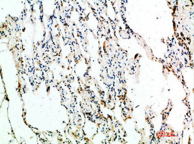 Immunohistochemical analysis of paraffin-embedded human-lung, antibody was diluted at 1:200Rabbit anti-Human ASCL1 Polyclonal Antibody
