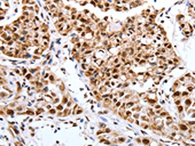The image on the left is immunohistochemistry of paraffin-embedded Human lung cancer tissue using Map2 Antibody(Map2 Antibody) at dilution 1/40, on the right is treated with synthetic peptide. (Original magnification: ×200)Rabbit Map2 Polyclonal Antibody