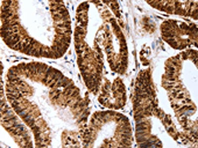 The image on the left is immunohistochemistry of paraffin-embedded Human colon cancer tissue using the antibody Antibody) at dilution 1/40, on the right is treated with synthetic peptide. (Original magnification: ×200)Rabbit Map2 Polyclonal Antibody