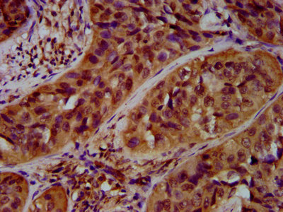 IHC image of the antibody diluted at 1:600 and staining in paraffin-embedded human cervical cancer performed on a Leica BondTM system. After dewaxing and hydration, antigen retrieval was mediated by high pressure in a citrate buffer (pH 6.0). Section was blocked with 10% normal goat serum 30min at RT. Then primary antibody (1% BSA) was incubated at 4°C overnight. The primary is detected by a biotinylated secondary antibody and visualized using an HRP conjugated SP system.Rabbit anti-Human ARHGAP15 Polyclonal Antibody