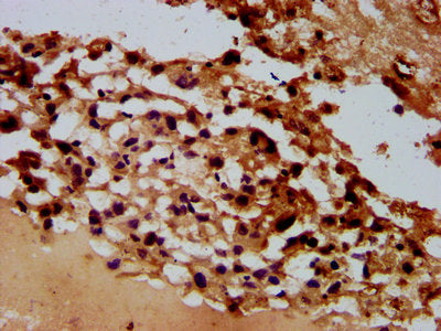 IHC image of ARHGAP15 Antibody diluted at 1:600 and staining in paraffin-embedded human melanoma performed on a Leica BondTM system. After dewaxing and hydration, antigen retrieval was mediated by high pressure in a citrate buffer (pH 6.0). Section was blocked with 10% normal goat serum 30min at RT. Then primary antibody (1% BSA) was incubated at 4°C overnight. The primary is detected by a biotinylated secondary antibody and visualized using an HRP conjugated SP system.Rabbit anti-Human ARHGAP15 Polyclonal Antibody