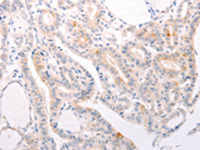 The image on the left is immunohistochemistry of paraffin-embedded Human thyroid cancer tissue using S1PR3 Antibody(S1PR3 Antibody) at dilution 1/30, on the right is treated with synthetic peptide. (Original magnification: ×200)Rabbit anti-Human S1PR3 Polyclonal Antibody