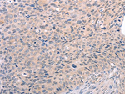The image on the left is immunohistochemistry of paraffin-embedded Human cervical cancer tissue using the antibody Antibody) at dilution 1/30, on the right is treated with synthetic peptide. (Original magnification: ×200)Rabbit anti-Human S1PR3 Polyclonal Antibody