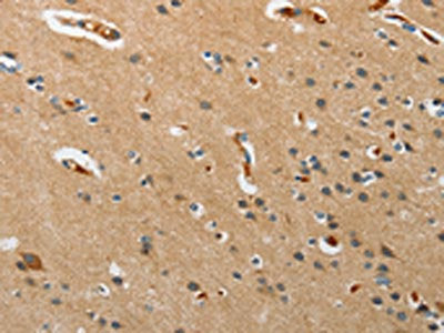 The image on the left is immunohistochemistry of paraffin-embedded Human brain cancer tissue using PITX3 Antibody(PITX3 Antibody) at dilution 1/15, on the right is treated with synthetic peptide. (Original magnification: ×200)Rabbit anti-Human PITX3 Polyclonal Antibody