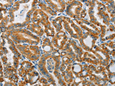 The image on the left is immunohistochemistry of paraffin-embedded Human thyroid cancer tissue using the antibody Antibody) at dilution 1/15, on the right is treated with synthetic peptide. (Original magnification: ×200)Rabbit anti-Human PITX3 Polyclonal Antibody