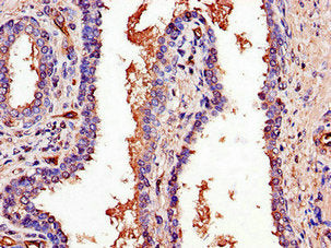 Immunohistochemistry of paraffin-embedded human prostate cancer using the antibody at dilution of 1:100Rabbit anti-Human PCOTH Polyclonal Antibody