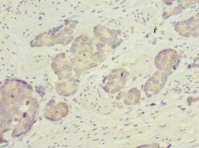 Immunohistochemistry of paraffin-embedded human gastric cancer using ACSBG2 Antibody at dilution of 1:100