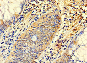 Immunohistochemistry of paraffin-embedded human colon cancer using SYTL3 Antibody at dilution of 1:100Rabbit anti-Human SYTL3 Polyclonal Antibody
