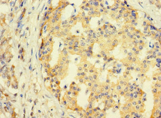 Immunohistochemistry of paraffin-embedded human pancreatic cancer using SYTL3 Antibody at dilution of 1:100Rabbit anti-Human SYTL3 Polyclonal Antibody