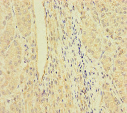 Immunohistochemistry of paraffin-embedded human liver cancer using RFTN2 Antibody at dilution of 1:100