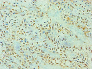 Immunohistochemistry of paraffin-embedded human breast cancer using the antibody at dilution of 1:100Rabbit anti-Human TP53I3 Polyclonal Antibody