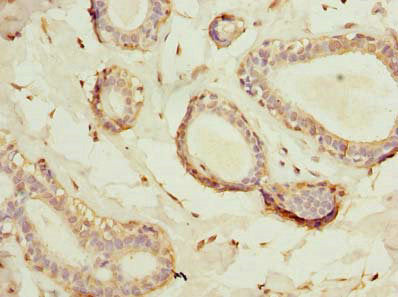 Immunohistochemistry of paraffin-embedded human breast cancer using HSD17B12 Antibody at dilution of 1:100Rabbit anti-Human HSD17B12 Polyclonal Antibody