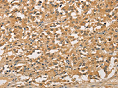 The image on the left is immunohistochemistry of paraffin-embedded Human thyroid cancer tissue using the antibody Antibody) at dilution 1/20, on the right is treated with fusion protein. (Original magnification: ×200)Rabbit anti-Human NFE2L1 Polyclonal Antibody