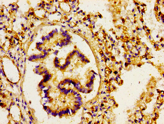 Immunohistochemistry of paraffin-embedded human lung tissue using ARHGAP1 Antibody at dilution of 1:100Rabbit anti-Human ARHGAP1 Polyclonal Antibody